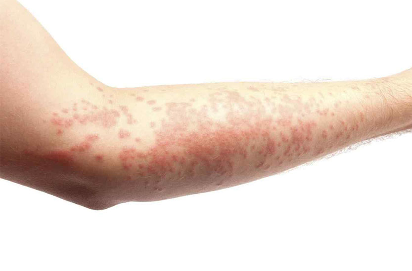 Photo of skin with hives or urticaria