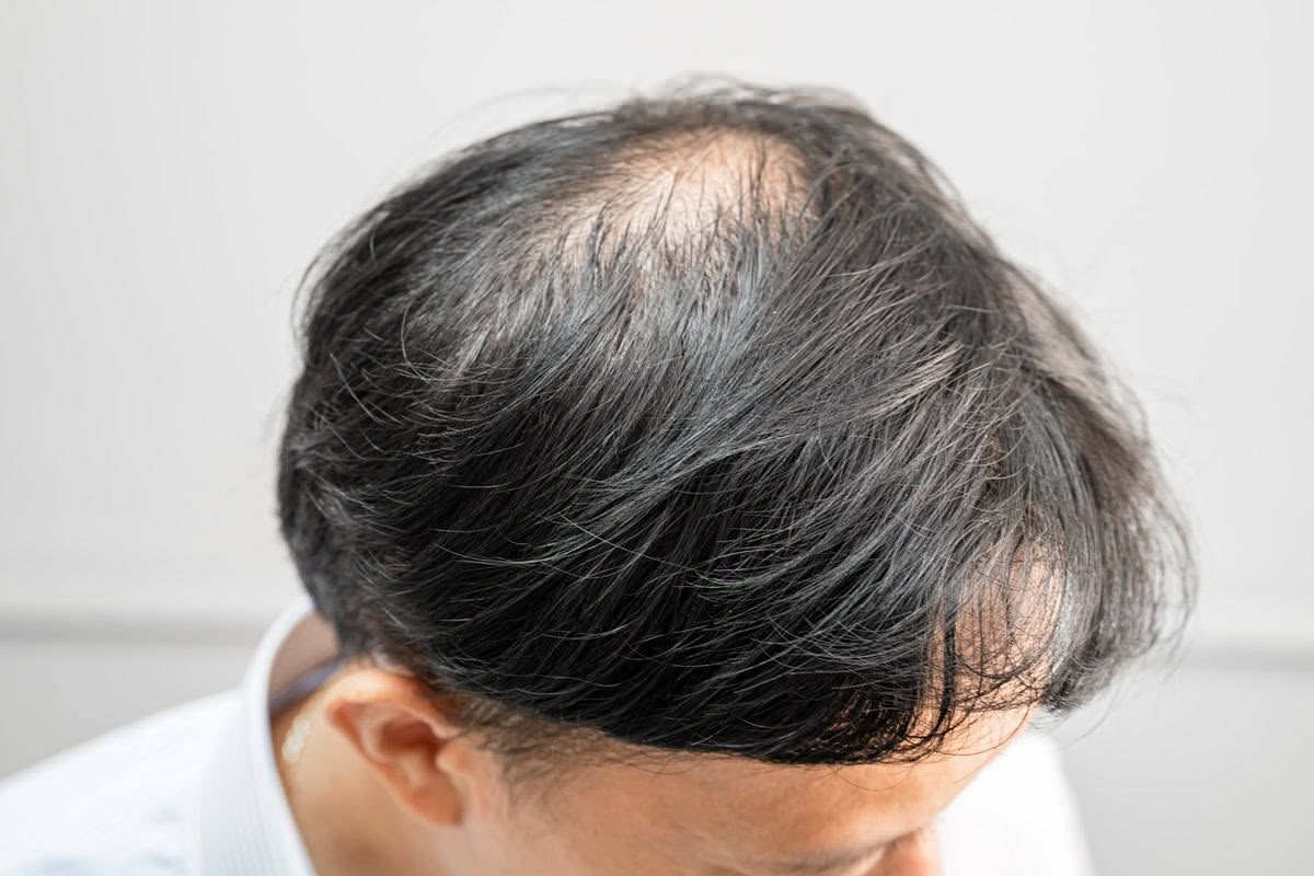 Modafinil and Hair Loss